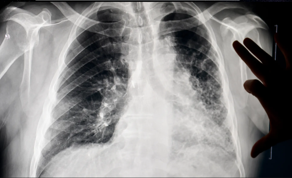 Black lung x ray